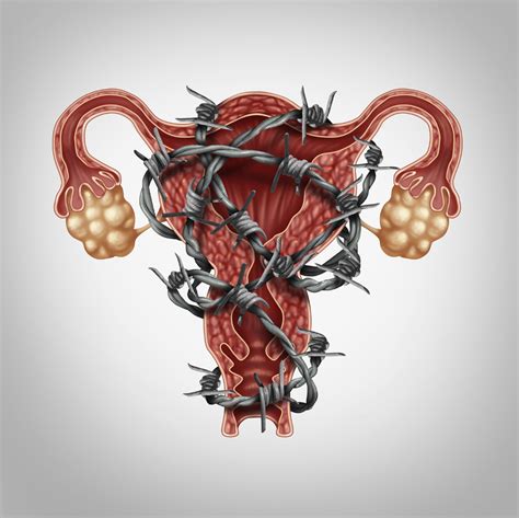 consecuencias de la endometriosis